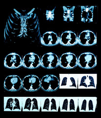 CT scan of the chest with 3D reconstruction.