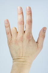 Amputated finger