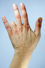 Amputated finger