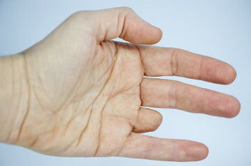 Amputated finger