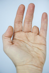 Amputated finger