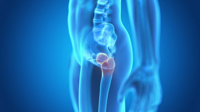 medical animaton - painful hip joint