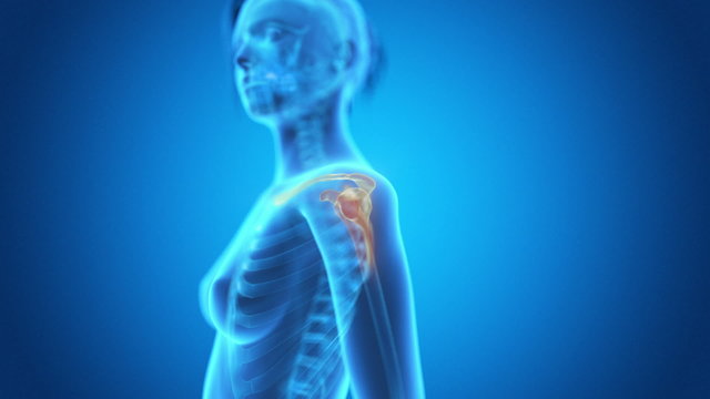 medical animation - pain in the shoulder