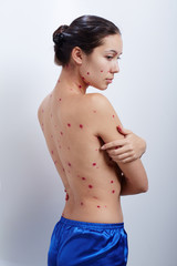 manifestation of chickenpox