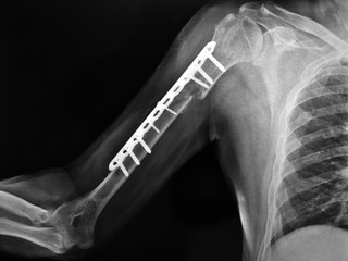 Radiografia del braccio.Frattura - obrazy, fototapety, plakaty