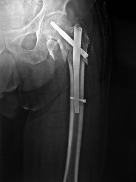 Radiografia del femore. Frattura