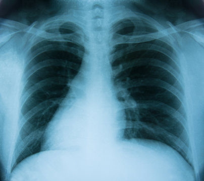 X-Ray Image Of Human Chest