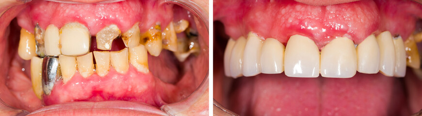 Denture Before and After Treatment