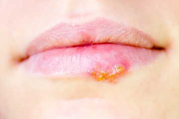 Herpes virus on female lips - obrazy, fototapety, plakaty