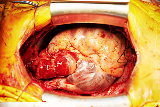 Cardiac surgery heart transplantation