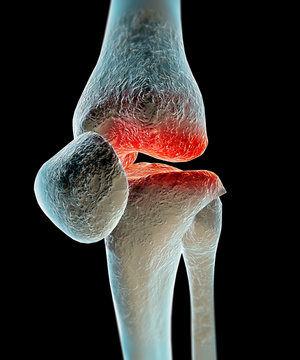Osteoartrosi, artrosi, malattia ginocchio, ossa