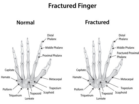 Fractured Finger