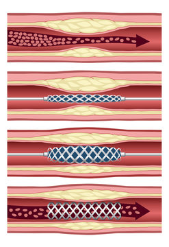 Implanting Artery Stent In Four Steps