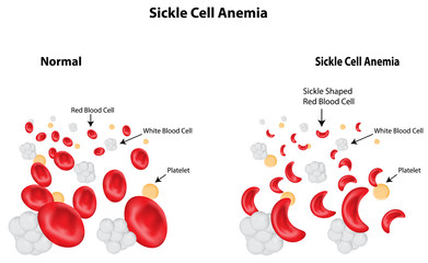 Sickle Cell Anemia