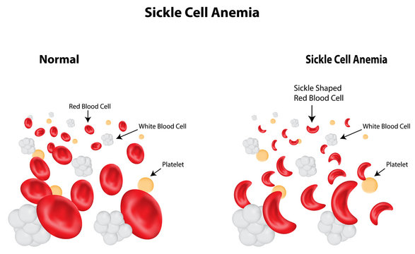 sickle cell vs normal cell