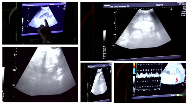 multiscreen Ultrasound baby in mother's womb