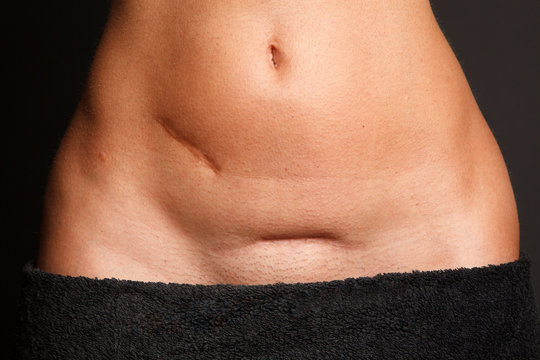 Bauch einer schlanken Frau mit 2 Narben