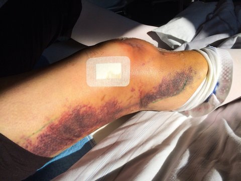 Knie mit Kniegelenksprotese und H&auml;matom