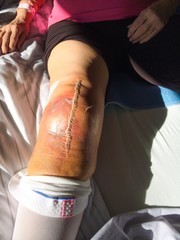 Frau nach einer Knieoperation - Kniegelenksprotese