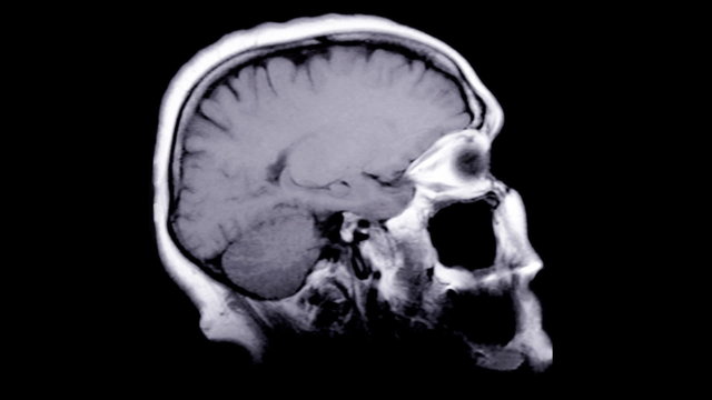 Computed tomography of the human brain.