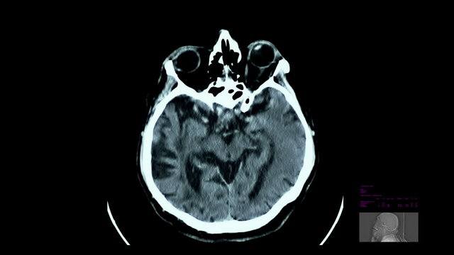 Brain scan, Cerebral venous congestion