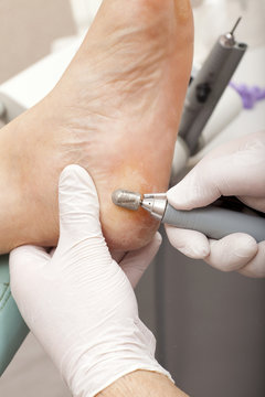 Fußpfleger entfernt mit Schleifmaschine Hornhaut