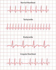 ECG Pathology DIsease