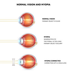Myopia and normal vision. Myopia is being shortsighted. - obrazy, fototapety, plakaty