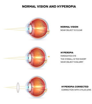 vitamincseppek a szem myopia számára rúnák a látáshoz