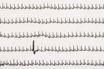 Extrasystole On Electrocardiogram Record Paper