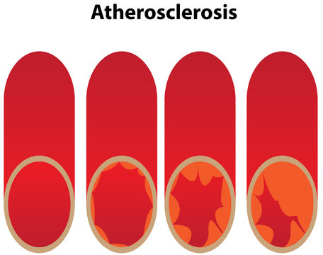 Athersclerosis