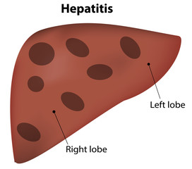Hepatitis Liver Disease