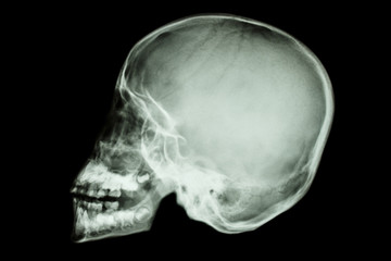 asian child's skull (Thai people)