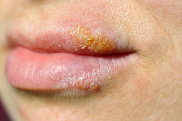 Obraz premium herpes