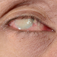 eye exam