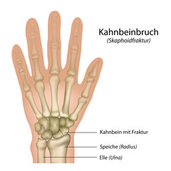Kahnbeinbruch, Skaphoidfraktur