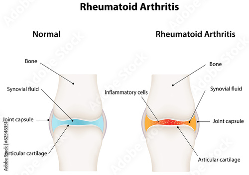review article rheumatoid arthritis review article rheumatoid arthritis