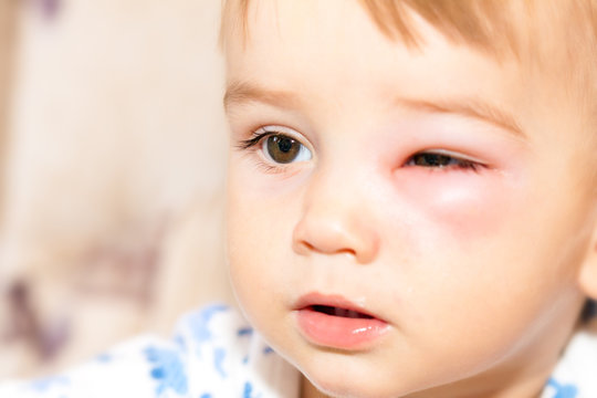Little Boy - Dangerous Stings From Wasps Near The Eye