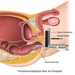 Prostatastanzbiopsie über ein Template