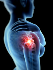 a woman having acute pain in the shoulder joint