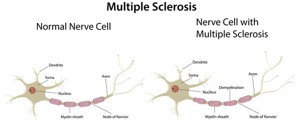 Multiple Sclerosis Labeled Diagram