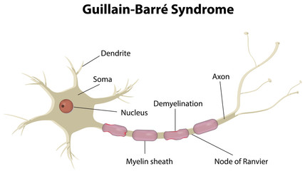Guillain-Barr&eacute; Syndrome