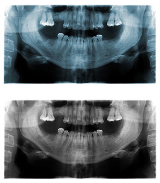 Panoramic dental X-Ray images