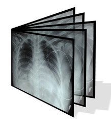Collage from chest X-rays. Isolated on white