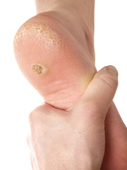 Dry skin under foot