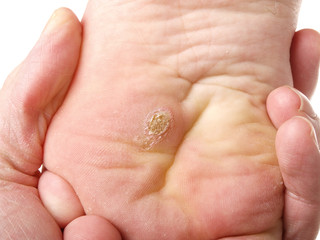 Dry skin under foot