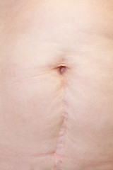 Naklejka premium Cesarean