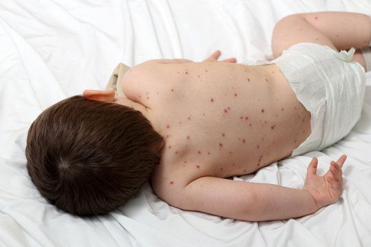 Chickenpox and baby