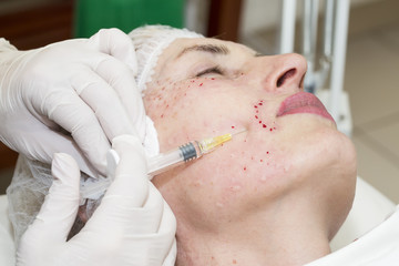 Cosmetic treatment with syringe injection in a clinic
