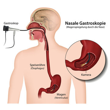 Nasale Gastroskopie, Magenspiegelung